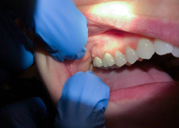 Best Emergency Dental Care for Broken or Chipped Teeth in St Hedwig, TX