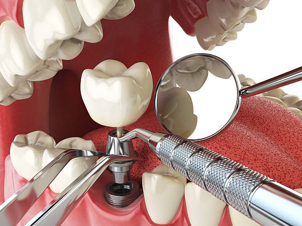 Best Emergency Tooth Extraction in St Hedwig, TX